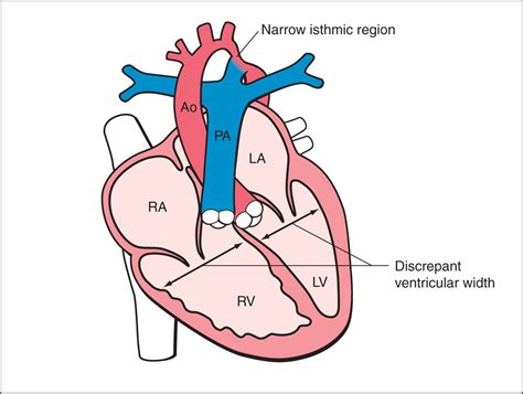 Coarctation of the Aorta and Interrupted Aortic Arch | Obgyn Key