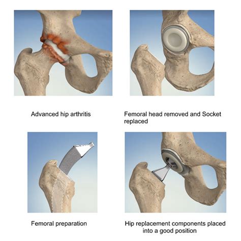 Total Hip Replacement | Hip Osteoarthritis