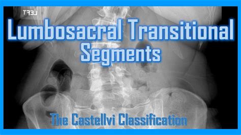 Lumbosacral Transitional Segments - LSTV #anatomy #radiology #medical ...