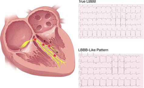 Left Bundle Branch Block | Circulation: Arrhythmia and Electrophysiology