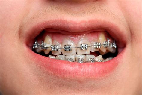 How Do Braces Work? - Braces or Invisalign