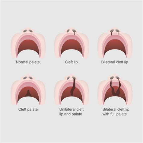 Types Of Cleft Palate Surgery - Infoupdate.org