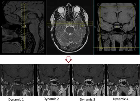 Pituitary MRI Protocols, Planing and Indications | Pituitary Dynamic