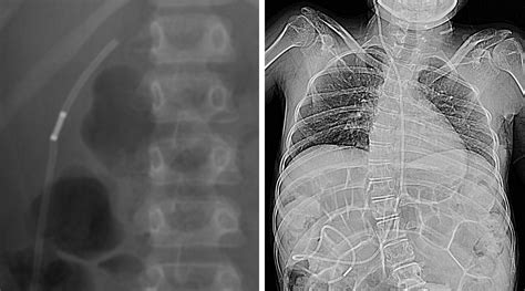 Ventriculo-Gallbladder Shunt | The Neurosurgical Atlas