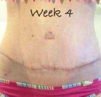 Swelling tummy tuck » Tummy Tuck: Prices, Photos, Reviews, Info, Q&A