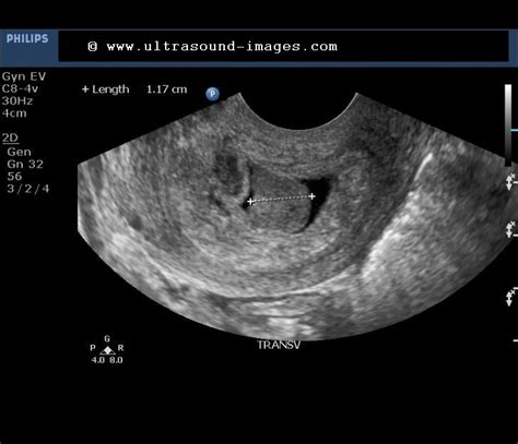 cochinblogs: Sonography in the case of pedunculated polyp