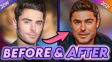 Zac Efron | Before & After | Why He REALLY Got Plastic Surgery? - YouTube