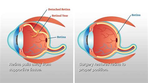 Retinal Detachment Surgery