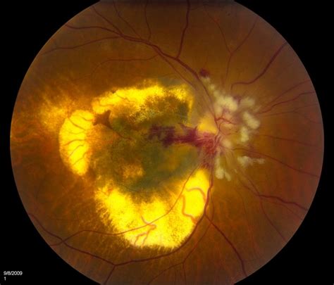 Treated Choroidal Melanoma - Retina Image Bank