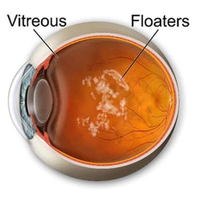 Floaters | Georgia Eye Clinic