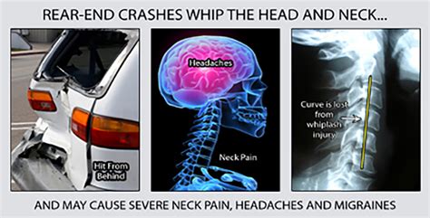 Whiplash Symptoms After a Car Accident | APSW | Hazlet NJ