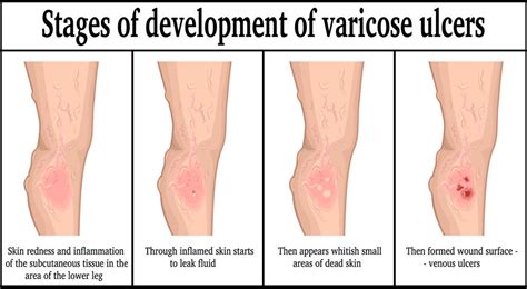 Diabetes Leg Discoloration - DiabetesWalls