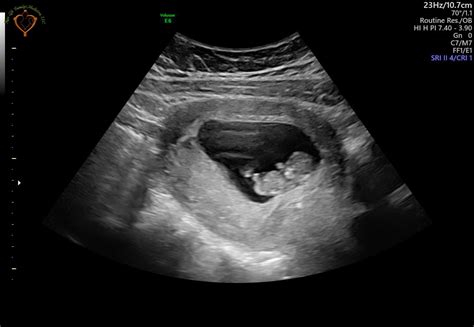 10 Week ultrasound! - July 2019 Babies | Forums | What to Expect