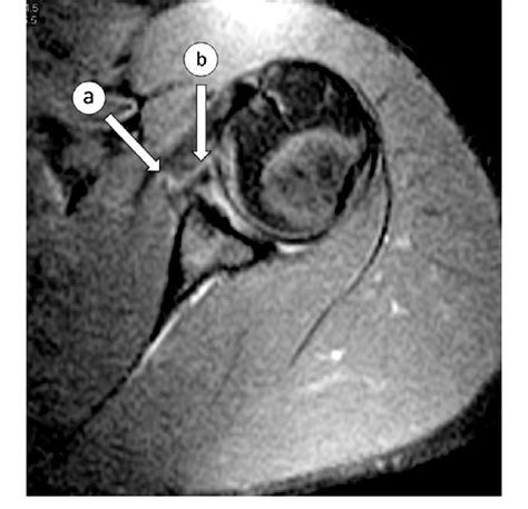 Bankart Lesion Mri