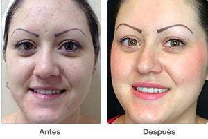 Antes y después - Exfoliación Química (Peeling) Hydrafaciales