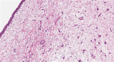 Sinonasal inflammatory polyp - MyPathologyReport.ca