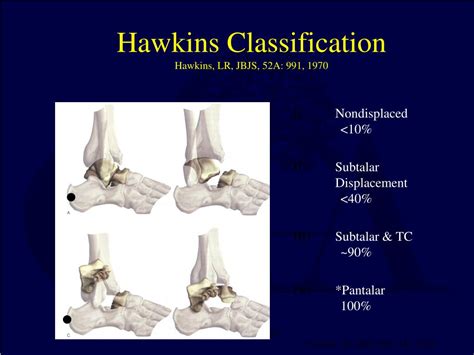 PPT - Fractures of the Talus and Subtalar Dislocations PowerPoint ...