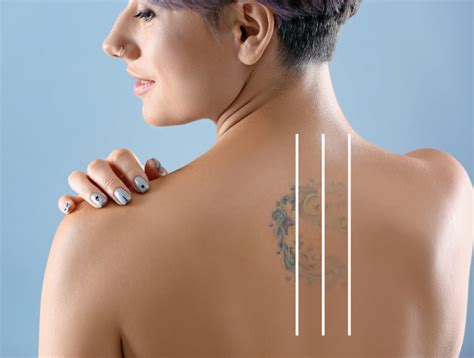 Tattoo Removal, Laser | Chicago| PicoSure | Derick Dermatology