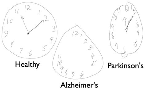 Clock Drawing Test Results - DRAWINGS OF LOVE