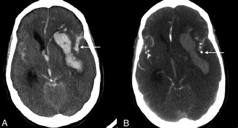 Brain Aneurysm Ct Scan - Diagnosis of a brain aneurysm may require ct ...