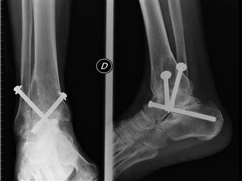 Arthroscopic Ankle and Subtalar Arthrodesis – Indications and Surgical ...