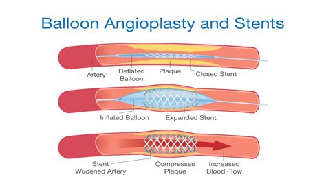 Coronary Angioplasty - Stents | Dr C RAGHU Cardiologist