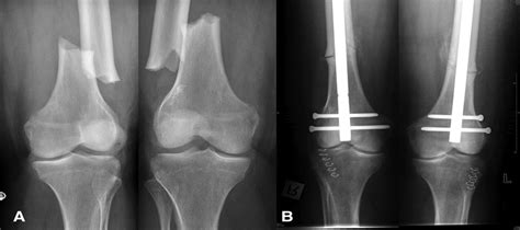 The Outcome of Surgically Treated Femur Fractures Associated ...