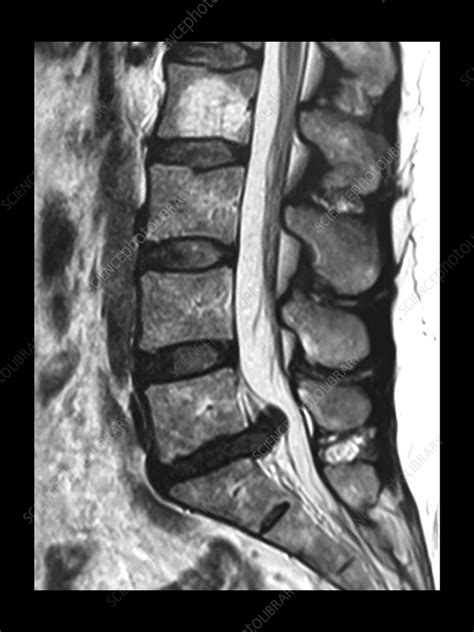 Large L5 S1 Disc Herniation MRI - Stock Image - C043/0183 - Science ...