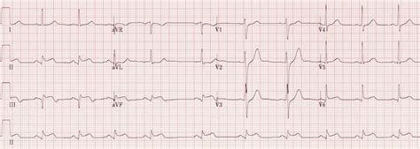 Inferior STEMI • LITFL • ECG Library Diagnosis