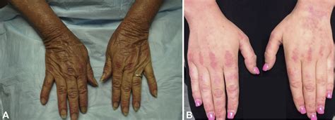 Dermatomyositis: Clinical features and pathogenesis - Journal of the ...