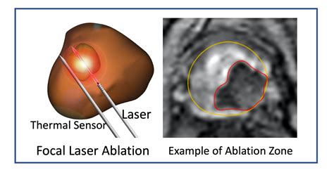 V14-04: Focal Laser Ablation of Prostate Cancer: An Office Procedure