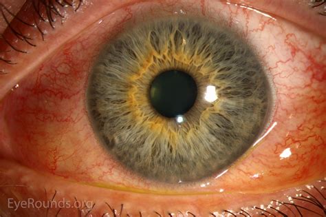 Atlas Entry - Bilateral chemosis in thyroid eye disease