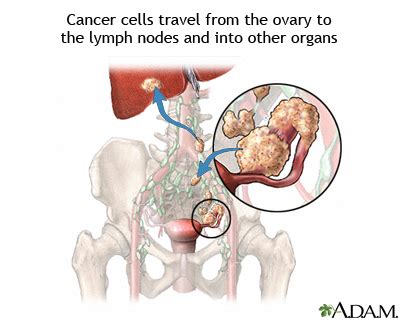 Ovarian cancer metastasis: MedlinePlus Medical Encyclopedia Image