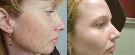 Pigmentation Treatment Kochi | Skin Whitening Kerala