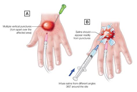 Infiltration Medical