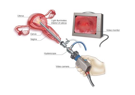 Best hysteroscopy centres in delhi, Hysteroscopy: Procedure, Uses ...