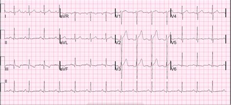 Dr. Smith's ECG Blog: Anterior ST elevation: Anterior STEMI? A ...