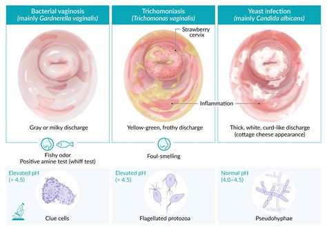 Trichomonas Vaginitis Discharge