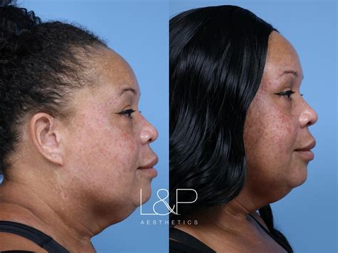 Ultherapy is offered at L&P Aesthetics by select providers, but can get ...