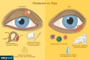 Chalazion vs. Stye: Symptoms, Causes, and Treatment