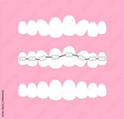 Vector illustration of the stages of orthodontic treatment braces on ...