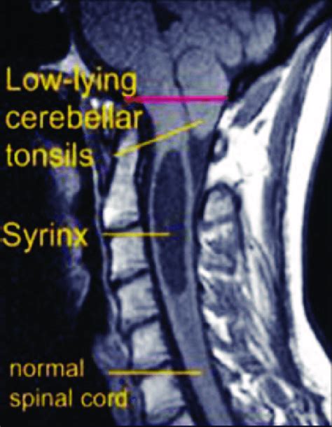 Foramen Magnum Mri