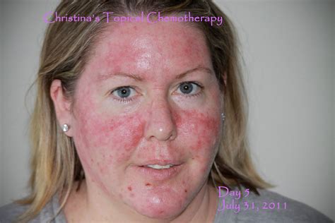 My Journey Through Topical Chemotherapy - Fluorouracil 5% Cream and ...