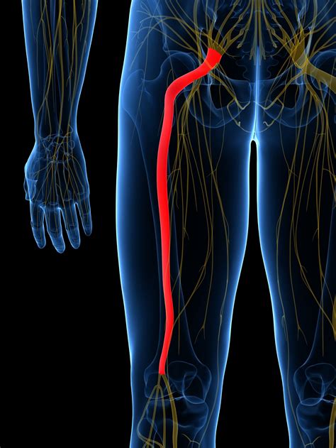 Sciatica: What It Is, Common Causes, and How to Fix It - ARC Health ...