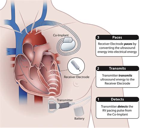 Pacemaker terminology - Questions and Answers in MRI