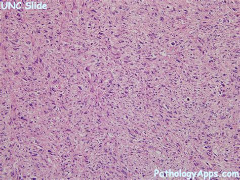 leiomyosarcoma uterus histology