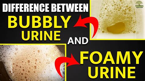 #shorts Difference Between Bubbly Urine and Foamy Urine | Kidney ...