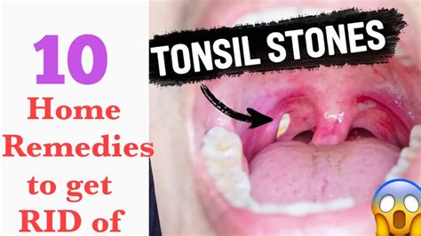 TONSIL STONES! WHAT CAUSES THEM AND 10 HOME REMEDIES TO GET RID OF THEM ...