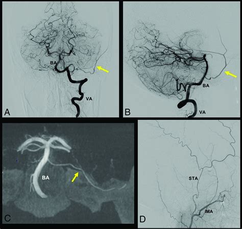 Middle Meningeal Artery: Anatomy and Variations | American Journal of ...