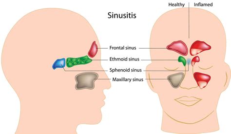 Sphenoid Sinus Anatomy